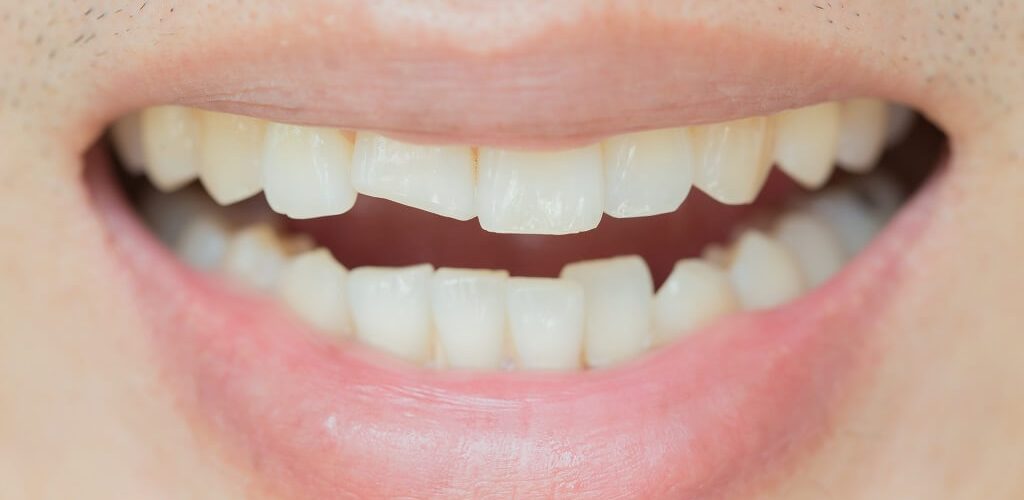 mutuelle dents
